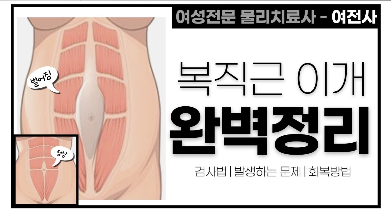 체형전문가가 알려주는 복직근이개 테스트 | 회복방법 diastasis recti abdominis
