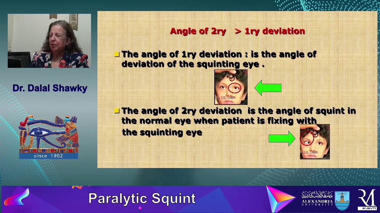 Paralytic squint , Professor Dalal Shawky ,Professor of Ophthalmology , Alexandria University, Egypt
