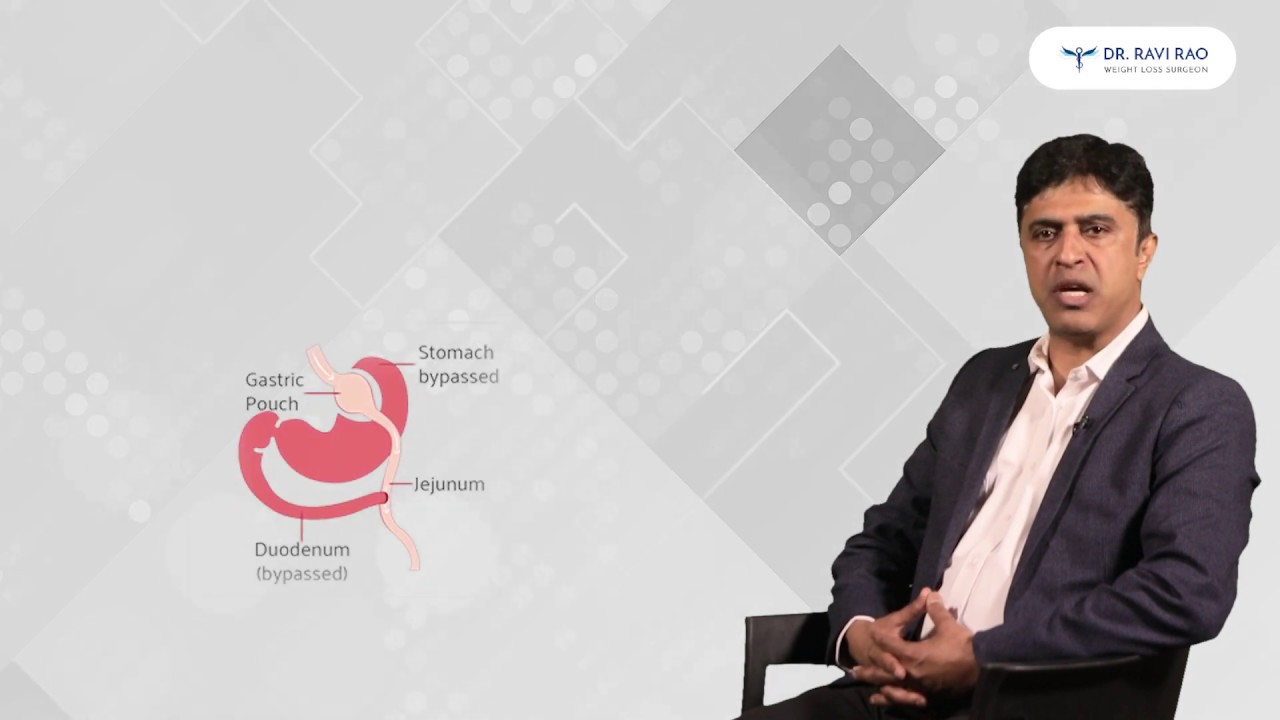 RNY Gastric Bypass Surgery | Gastric Bypass- Most Common Bariatric Surgery Procedure| Dr Ravi Rao