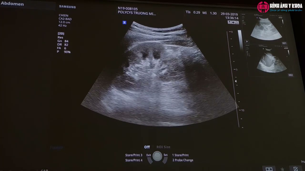 64. Hướng dẫn thực hành siêu âm Doppler động mạch thận – ThS.BS Nguyễn Quang Thái Dương (SATQ ĐHYD)