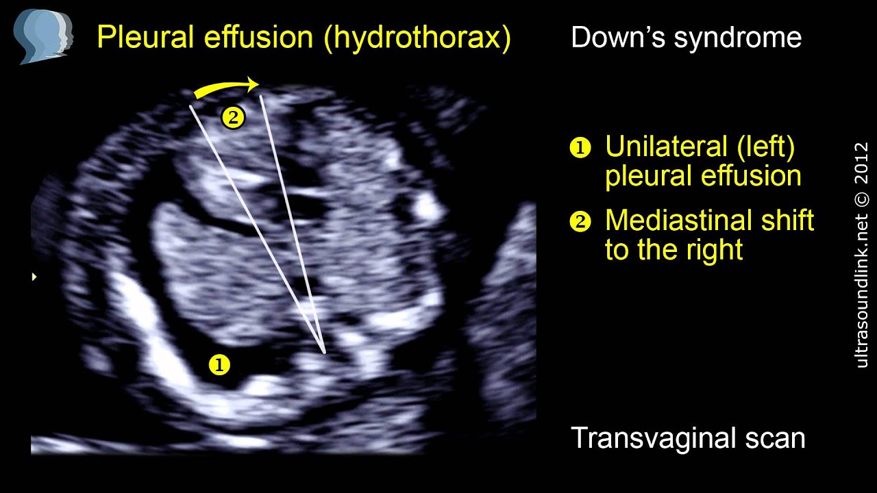 Pleural effusion (hydrothorax) at 11-13 weeks