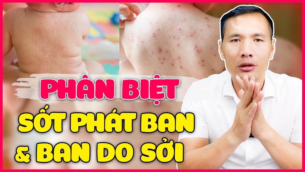 Phân biệt Ban do Sốt phát ban và Ban do Sởi ở trẻ - Cách chăm sóc trẻ| Dược sĩ Trương Minh Đạt