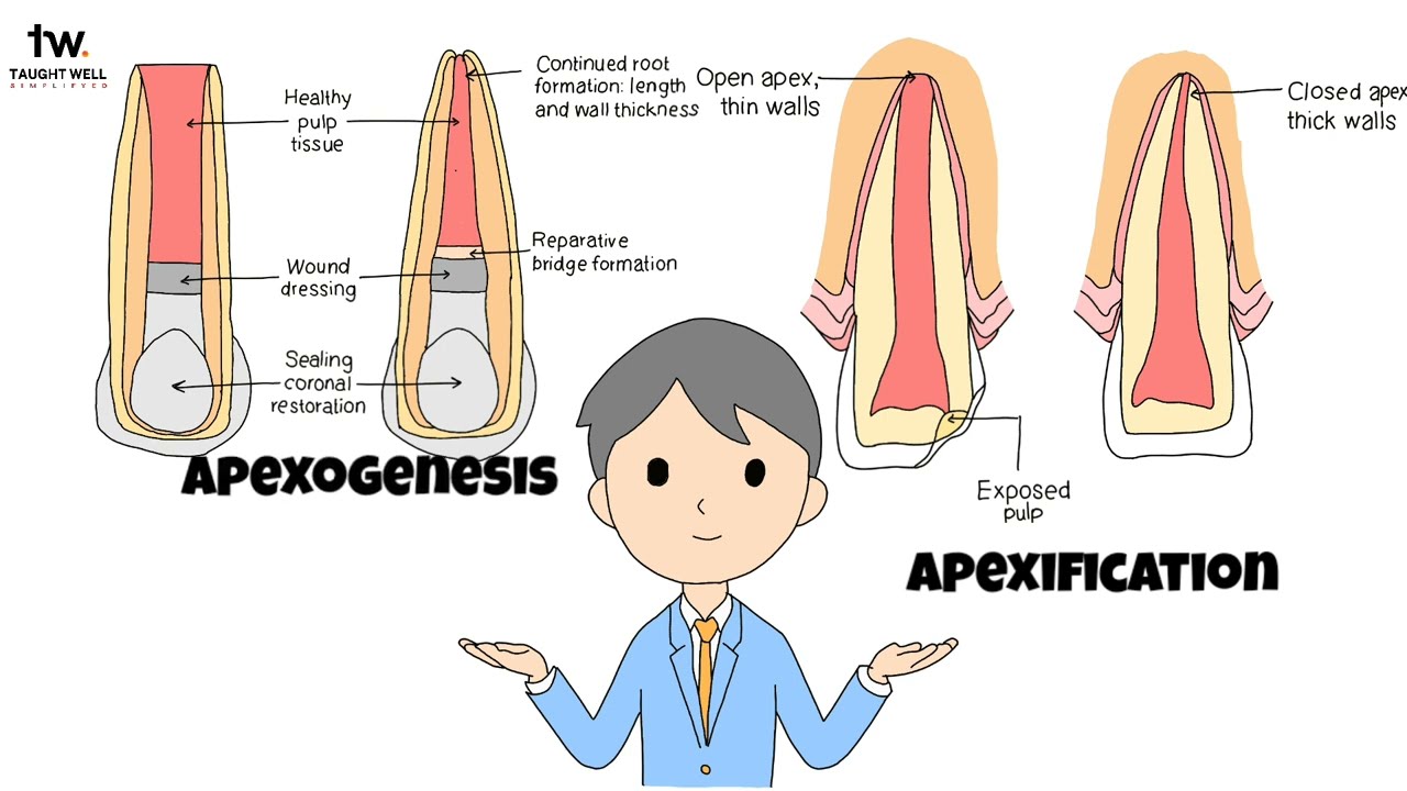 Apexogenesis and Apexification: Mastering Endodontic Procedures as a Dental Student