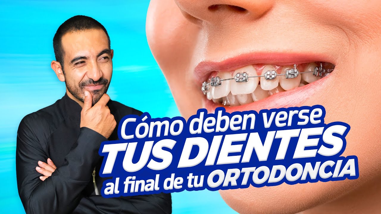 Así Deben Verse Tus Dientes Después de los Brackets