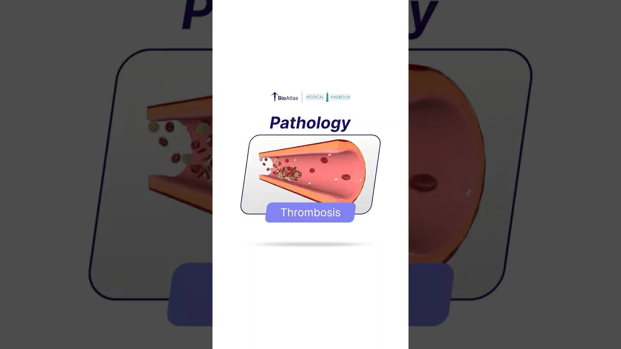 Thrombosis | Pathology | BioAtlas