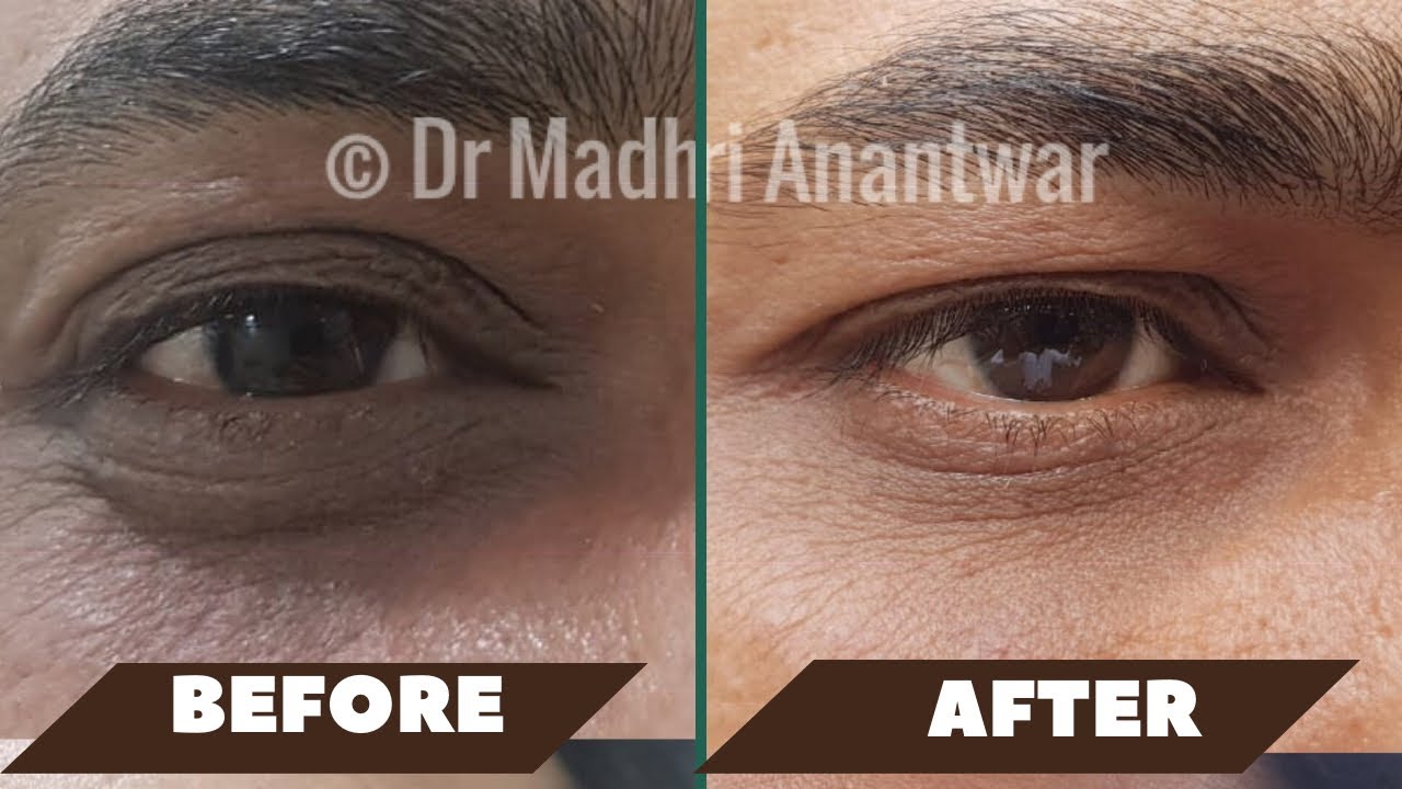 The TRUTH About Dark Circles (and how to treat them)