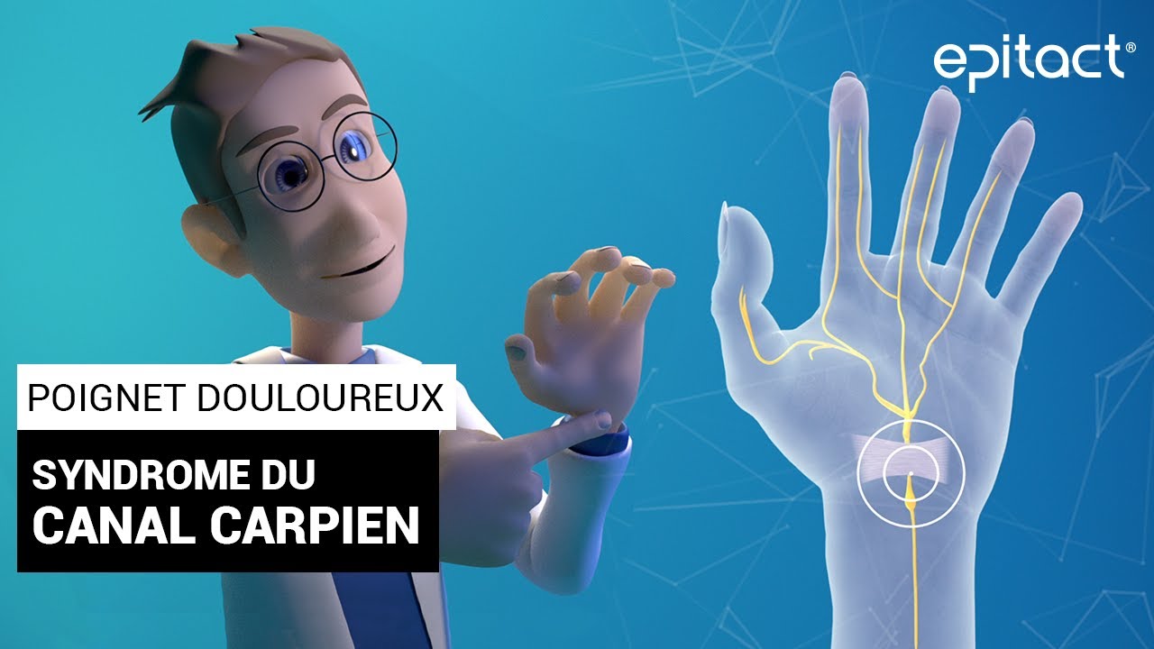 Syndrome du Canal Carpien | Explications – EPITACT
