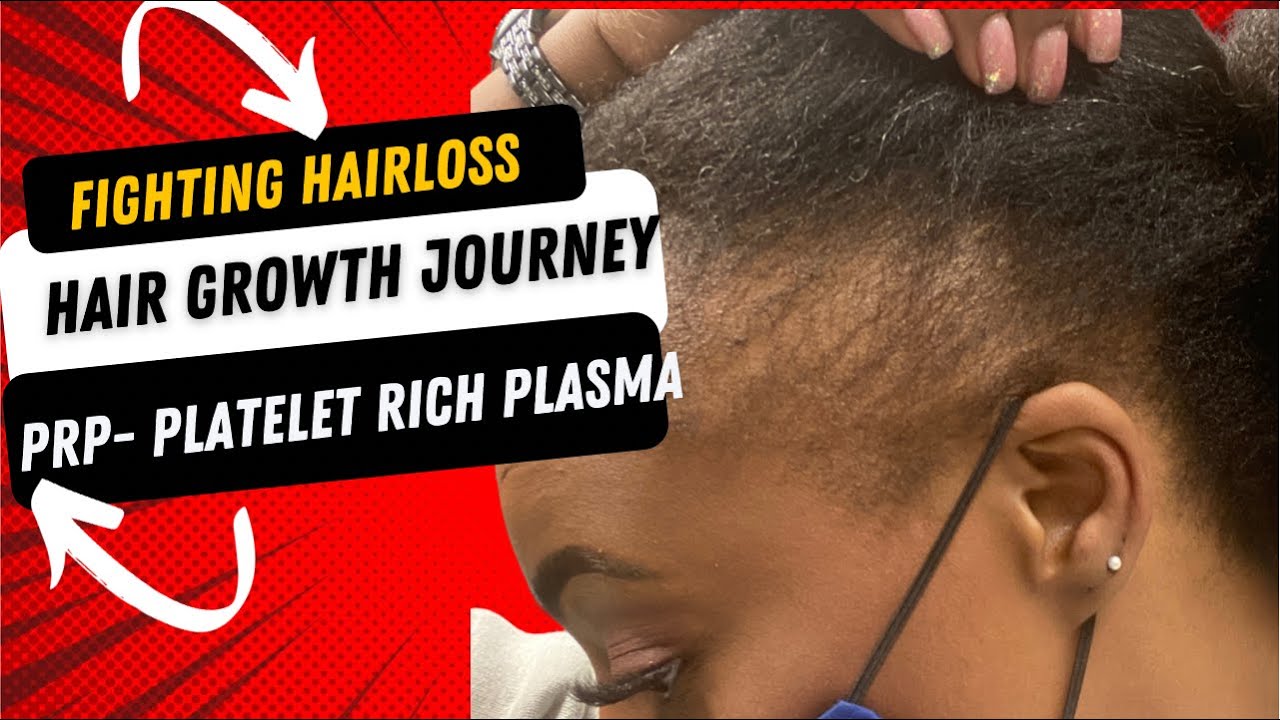 Combating Hair Loss (Covid side effect) with PRP- Platelet Rich Plasma Therapy