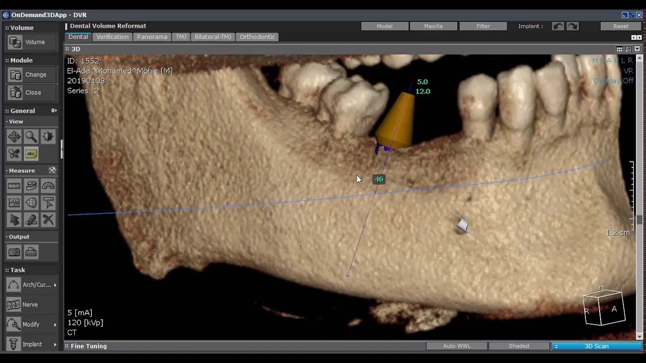 CBCT planning for implant part 3