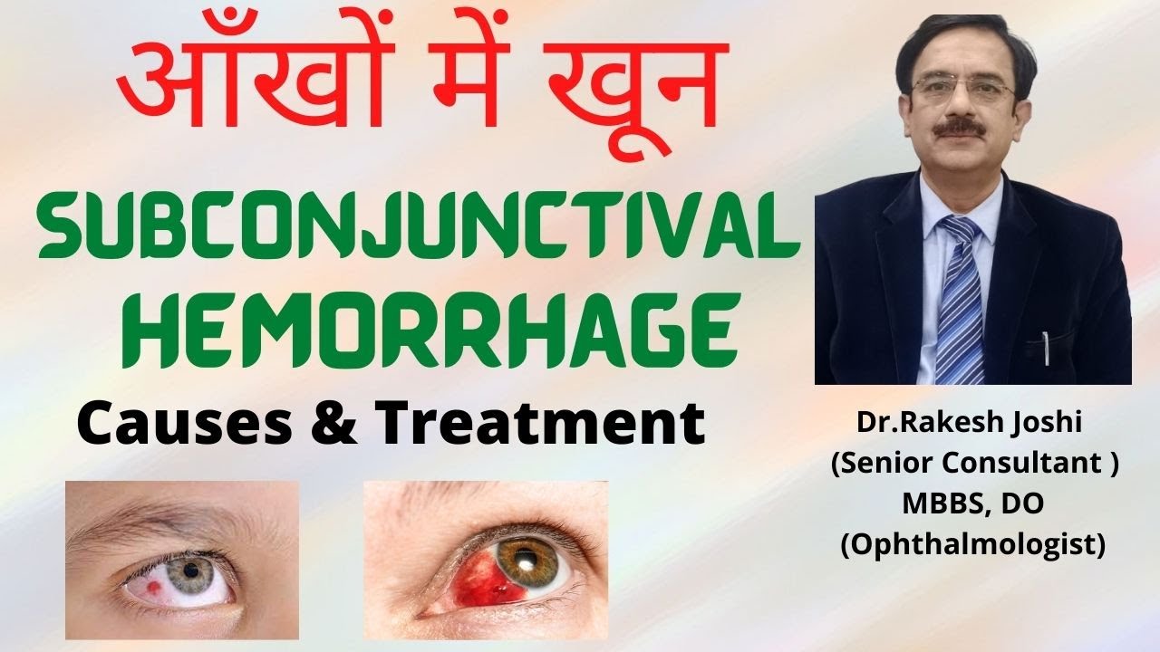 आँखों में खून जमने का कारण ?? II Subconjunctival hemorrhage II Causes & Treatment