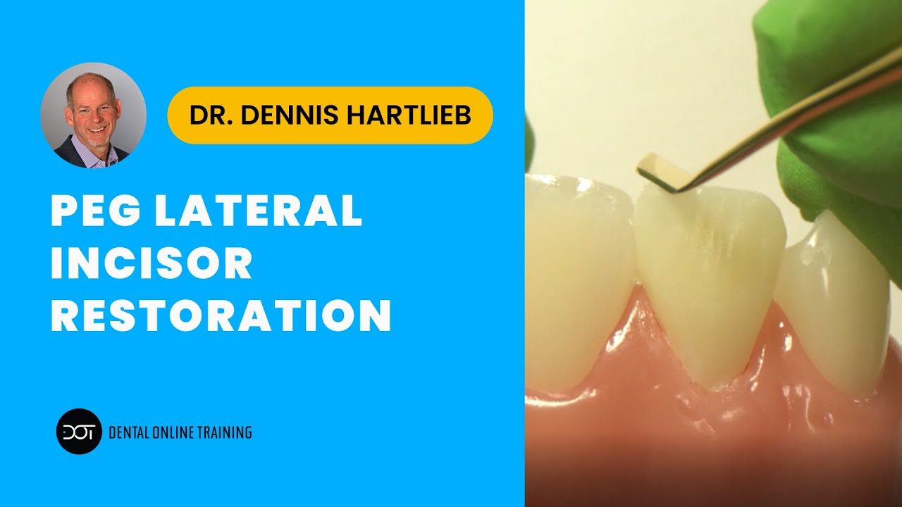 Peg Lateral Incisor Restoration
