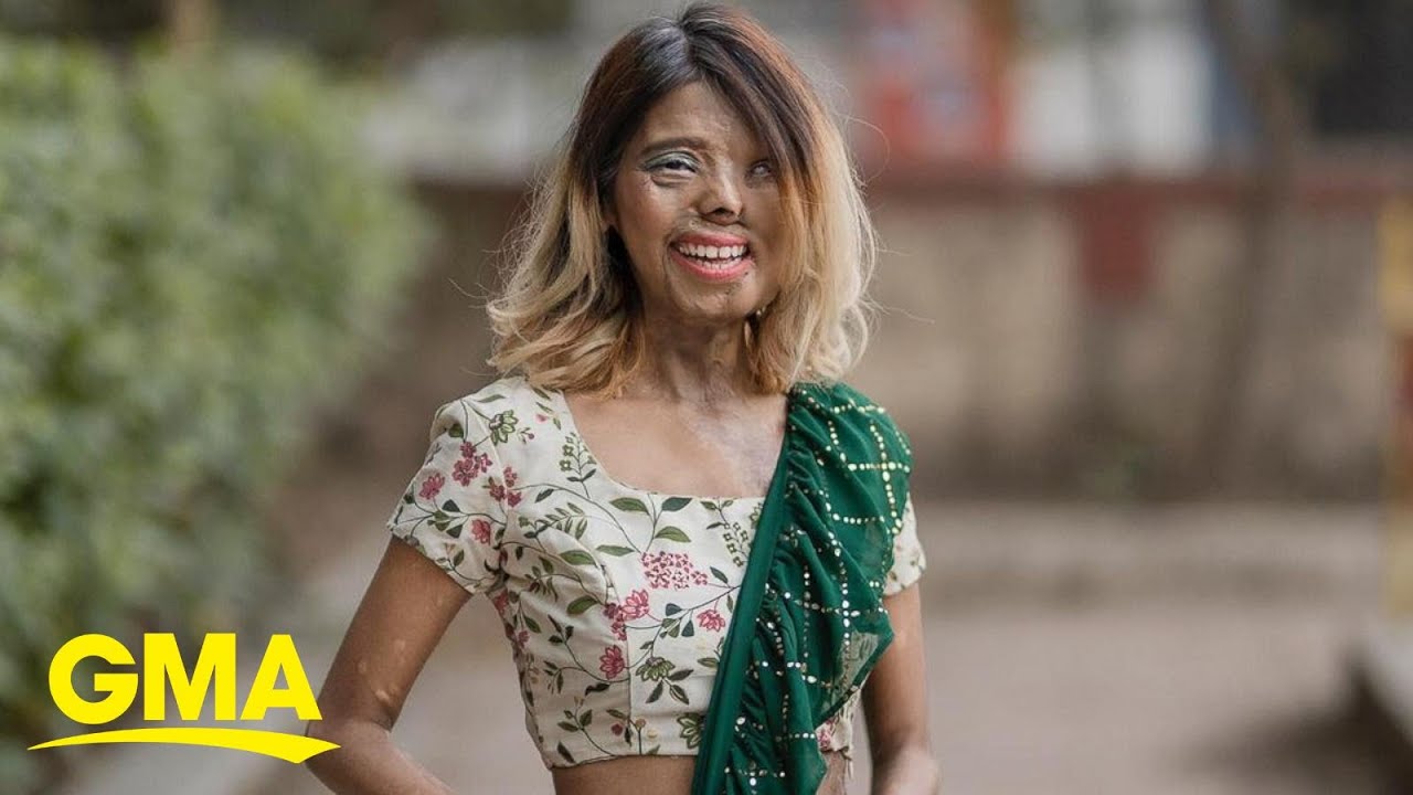 This acid attack survivor is redefining beauty | GMA