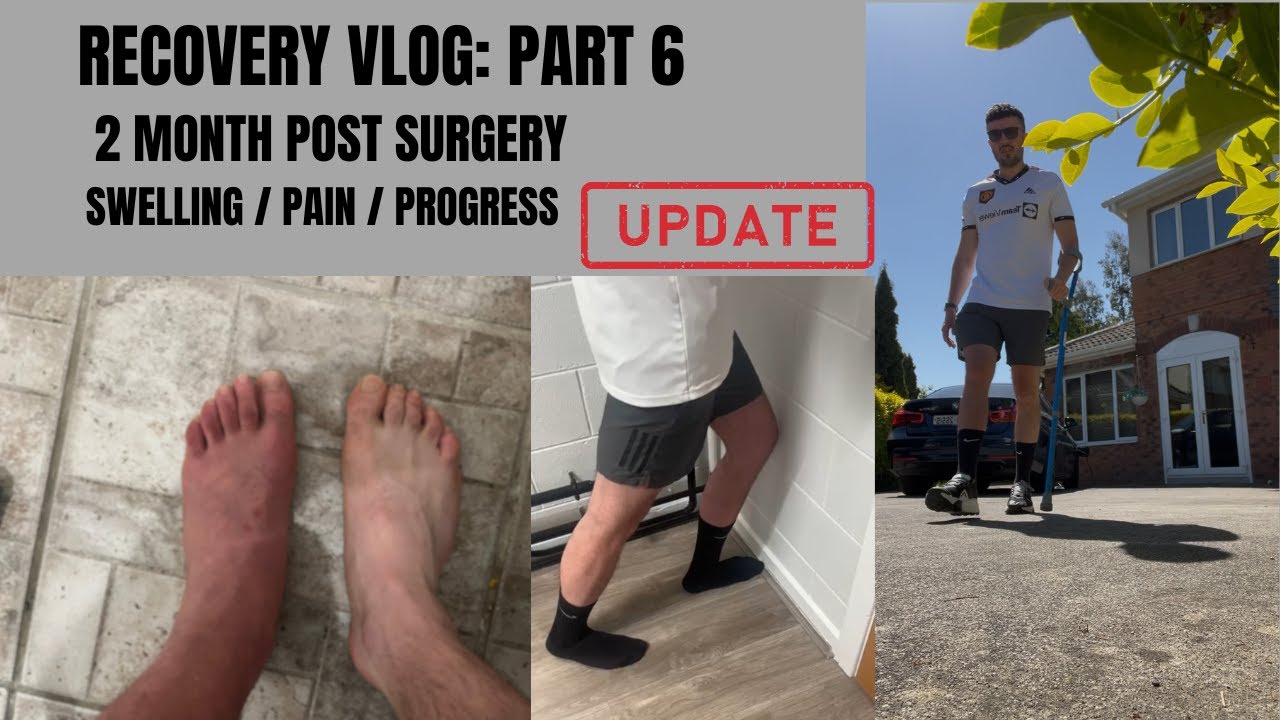 My Ankle Surgery Recovery: Updates On Physio, Pain & Stiffness 8 Weeks In!