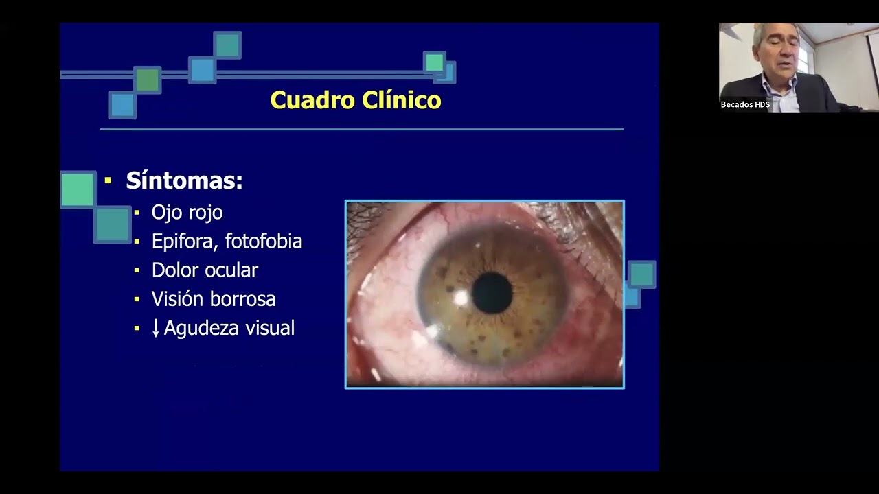 Toxoplasmosis ocular