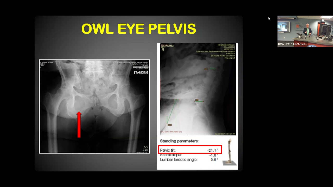 UVA Ortho Grand Rounds with Dr. Douglas Dennis (Colorado Bone and Joint)