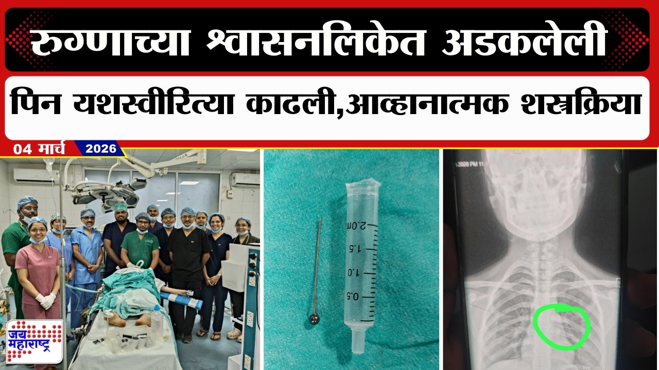 Sambhajinagar | रुग्णाच्या श्वासनलिकेत अडकलेली पिन यशस्वीरित्या काढली,आव्हानात्मक शस्त्रक्रिया
