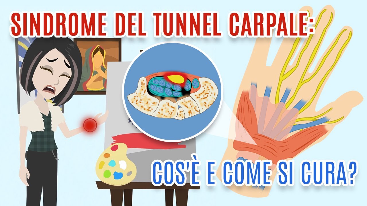 SINDROME DEL TUNNEL CARPALE: Cos'è e come si cura?