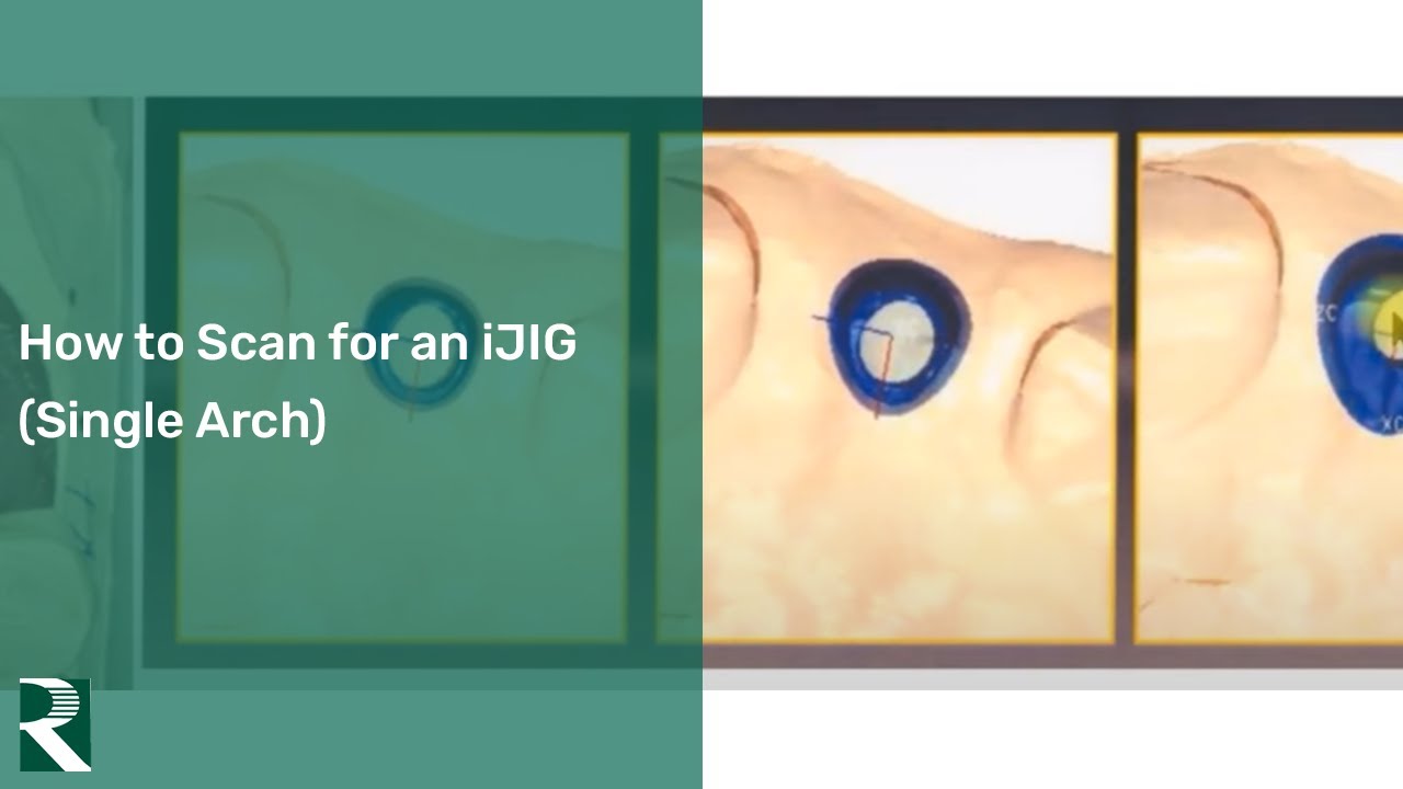 Stock vs Custom Ti Abutments - Let Us Help You Make The Right Choice