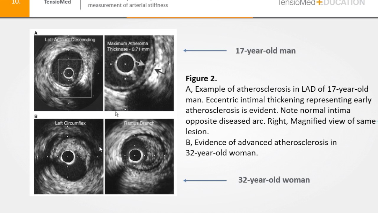 Arteriograph Training 1/7 : Arterial Stiffness