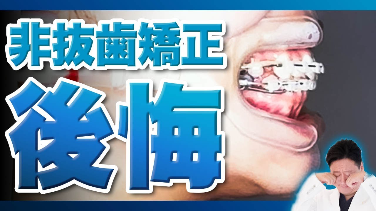 矯正終了後に再矯正！矯正治療でガチャ歯を改善するもEラインが気になる...【審美歯科 歯列矯正 歯並び 後悔 非抜歯】