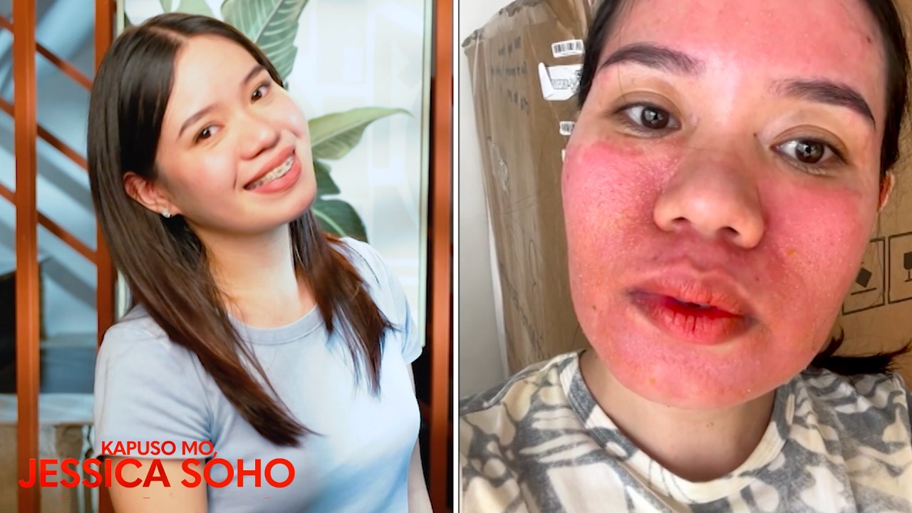 Babae, nagkapaltos at nasunog ang mukha matapos gumamit ng face serum?! | Kapuso Mo, Jessica Soho