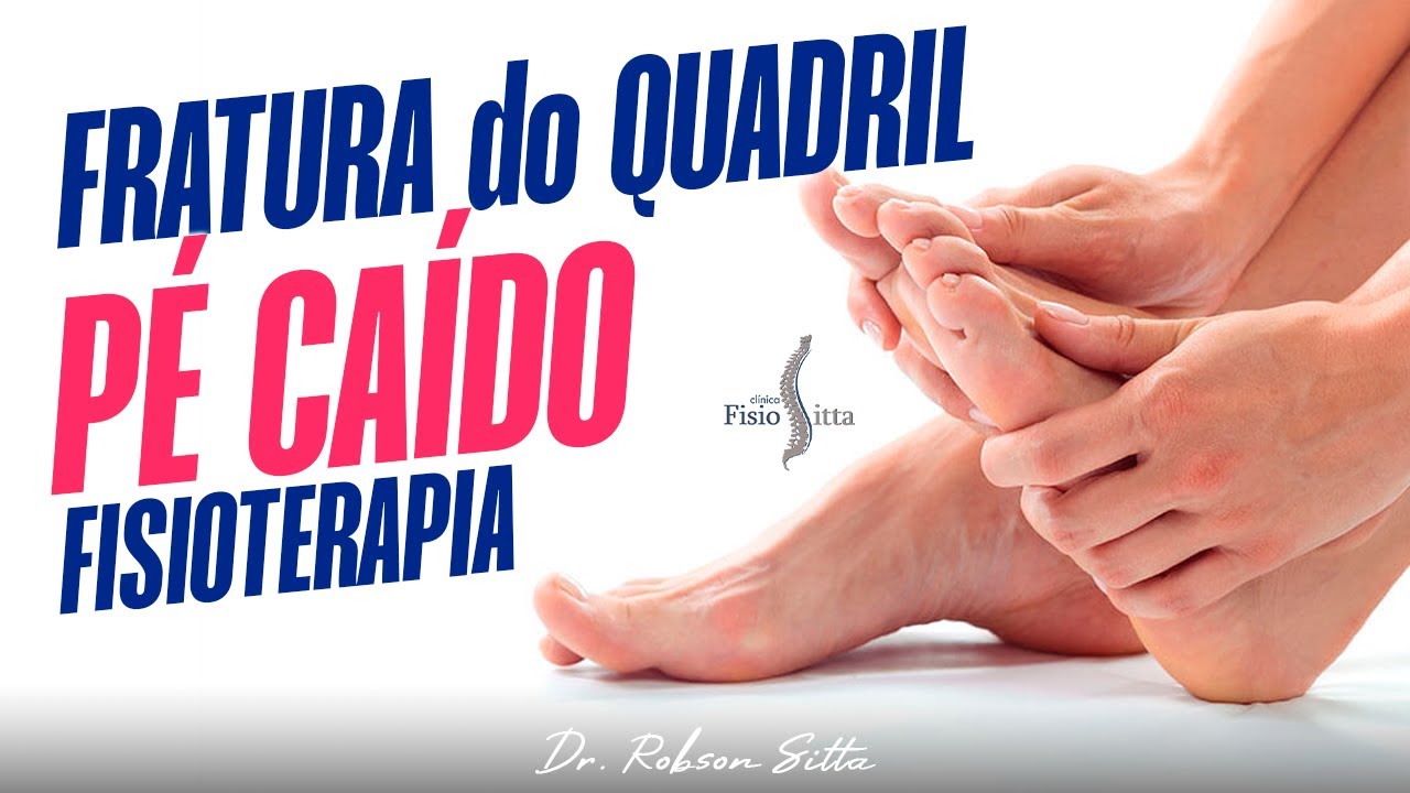 PÉ CAÍDO FRATURA LUXAÇÃO do QUADRIL e LESÃO NERVO CIÁTICO FISIOTERAPIA PÓS CIRURGIA Dr. Robson Sitta