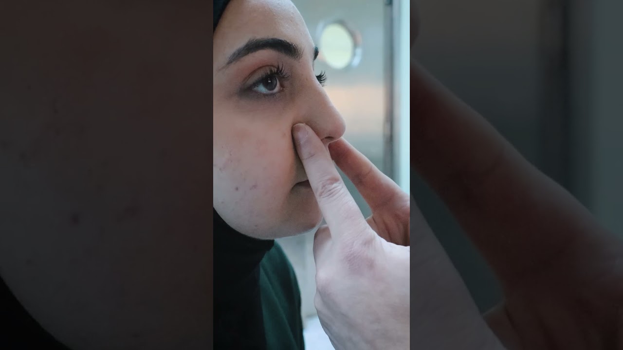 المساج بعد عملية تجميل الانف - د طارق دعاس حلب