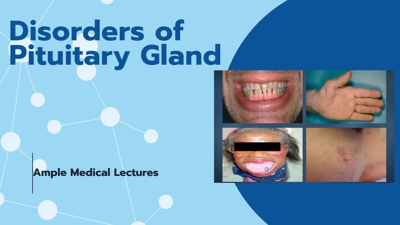 Endocrine Lecture on Disorders of Pituitary Gland | Medical Students Guide | Ample Medical Lectures