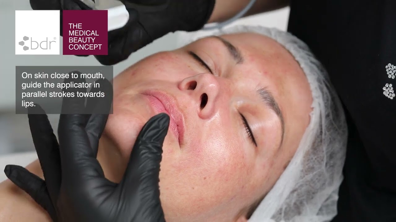 EN: bdr medical beauty concept: training dermabrasion Micropeel