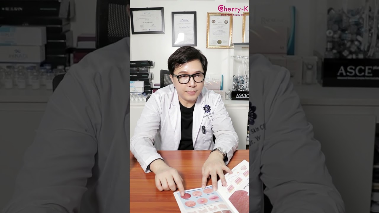 ဝက်ခြံထွက်လာရင် ဘာတွေသတိထားရမလဲ?? 🤔💭 #youtube #cherryk #skincare #acne #knowledge #ဝက်ခြံ