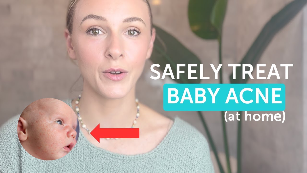 [How To] Safely Treat Baby Acne NATURALLY at Home