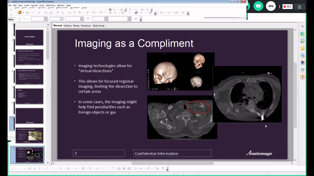 Forensic Radiology Webinar: Apply Virtual Dissection Technology To Autopsy