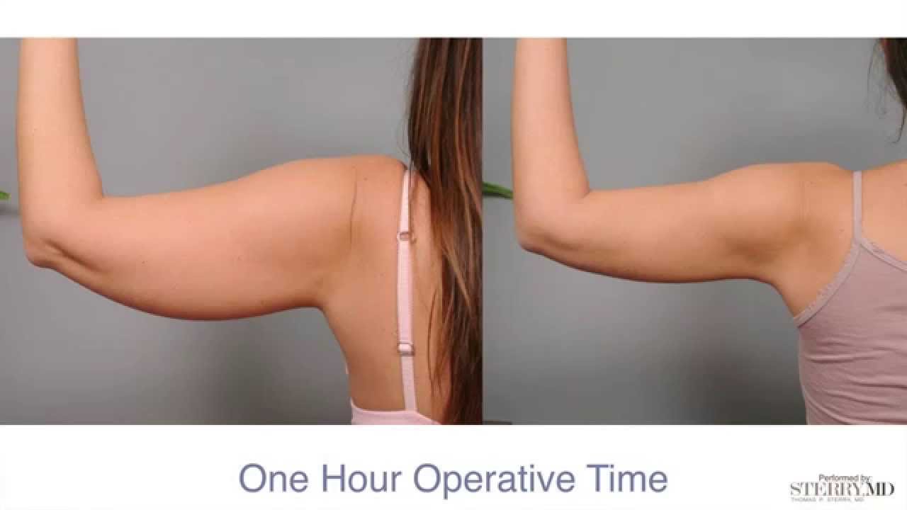Get Firm, Sculpted Arms With Smartlipo™ | Dr. Sterry Explains