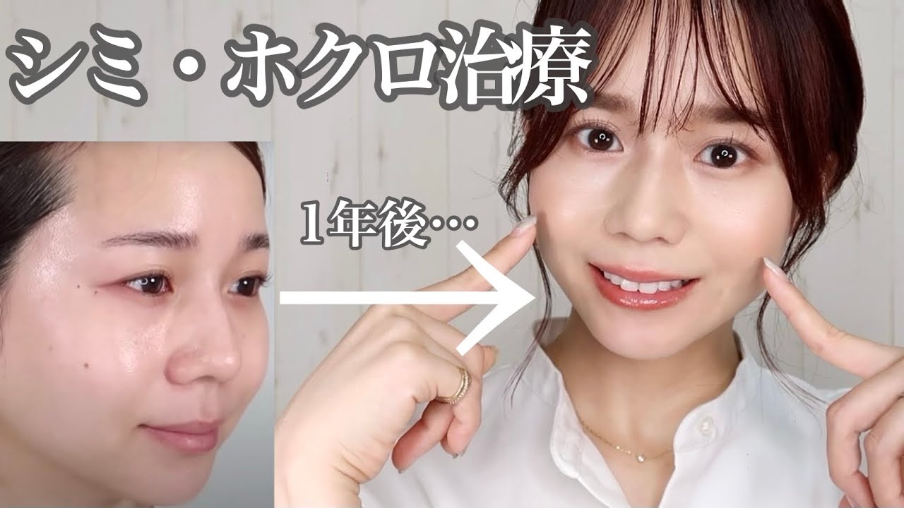【ホクロ・シミ取り】レーザー治療！１年後の経過報告&再発治療【３０代美容】