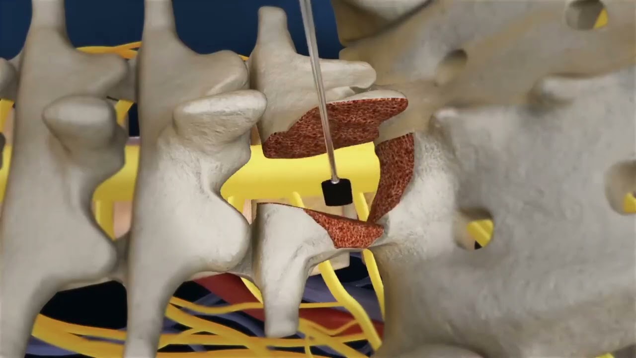 ORIF,Lumbar 5,S1 Fusion #hospital #doctor #patient #mbbsstudent #medicallife #instrument #surgeon