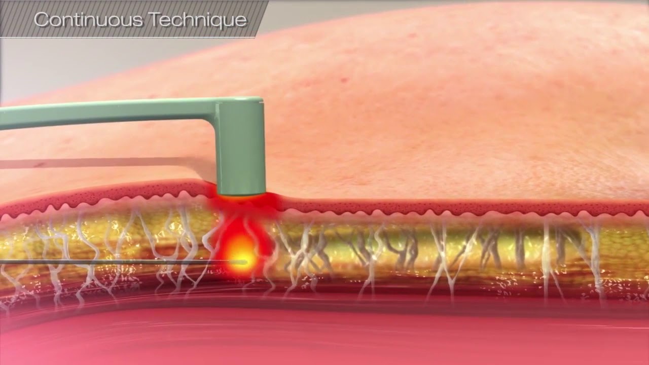 FaceTite Non-Surgical Skin Tightening at Vein & Cosmetic Center of Tampa Bay