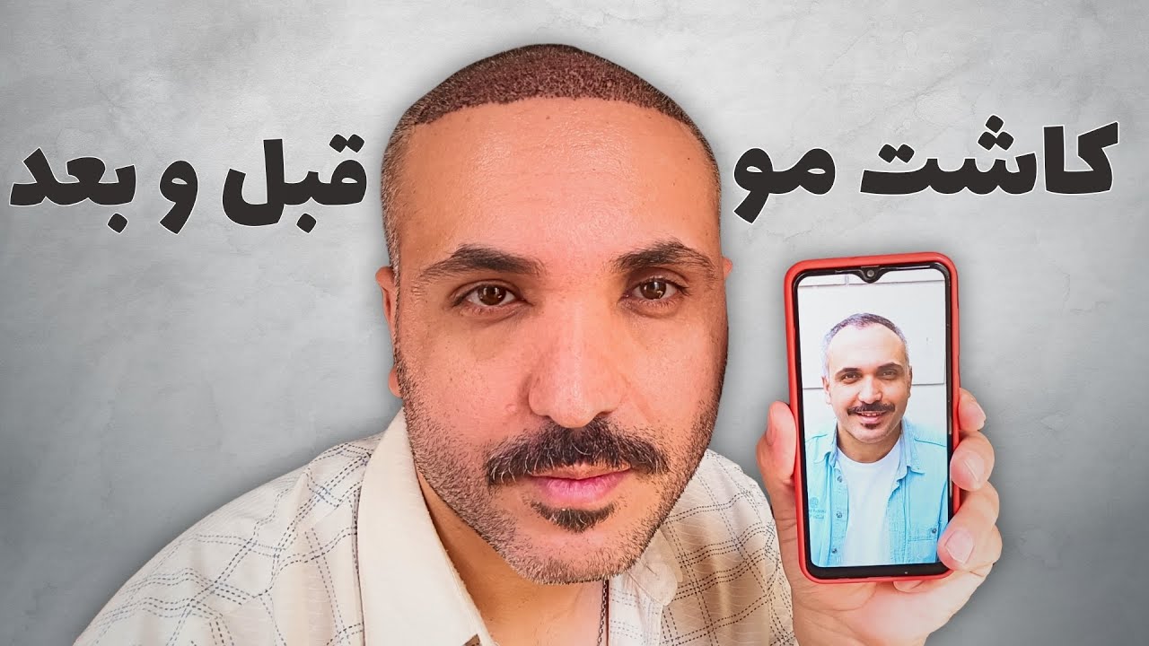 قبل و بعد کاشت مو | روند  رشد مو بعد از کاشت تا یک سال و نیم  🌱#hair_transplant