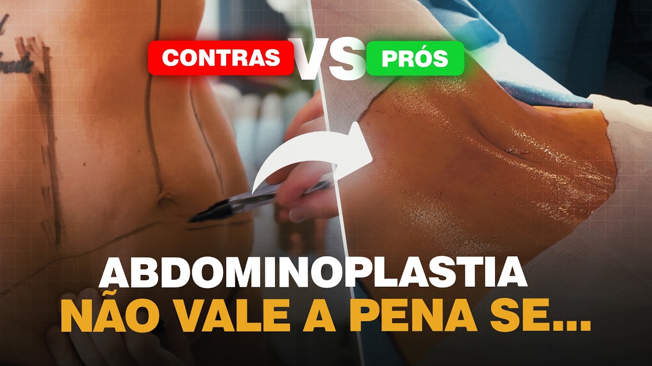VALE A PENA FAZER ABDOMINOPLASTIA 3 PRÓS E 3 CONTRAS (A VERDADE QUE QUASE NINGUÉM TE FALA)| Dr Ícaro