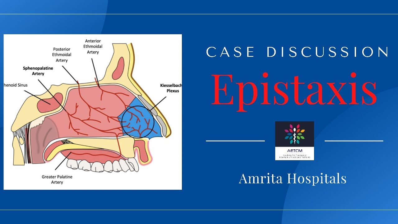 Epistaxis || Case Discussion