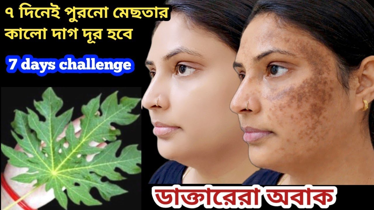 পেঁপে পাতা  দিয়ে কঠিন মেছতার তার দাগ দূর হবে চিরতরে / Reduce, Melasma, discussion, blackspots 