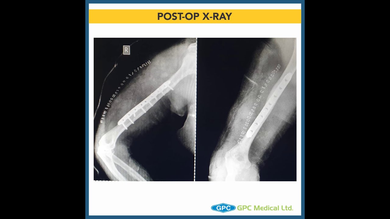 Midshaft Humerus Fracture - Operate or Treat Conservatively | GAITS Academy