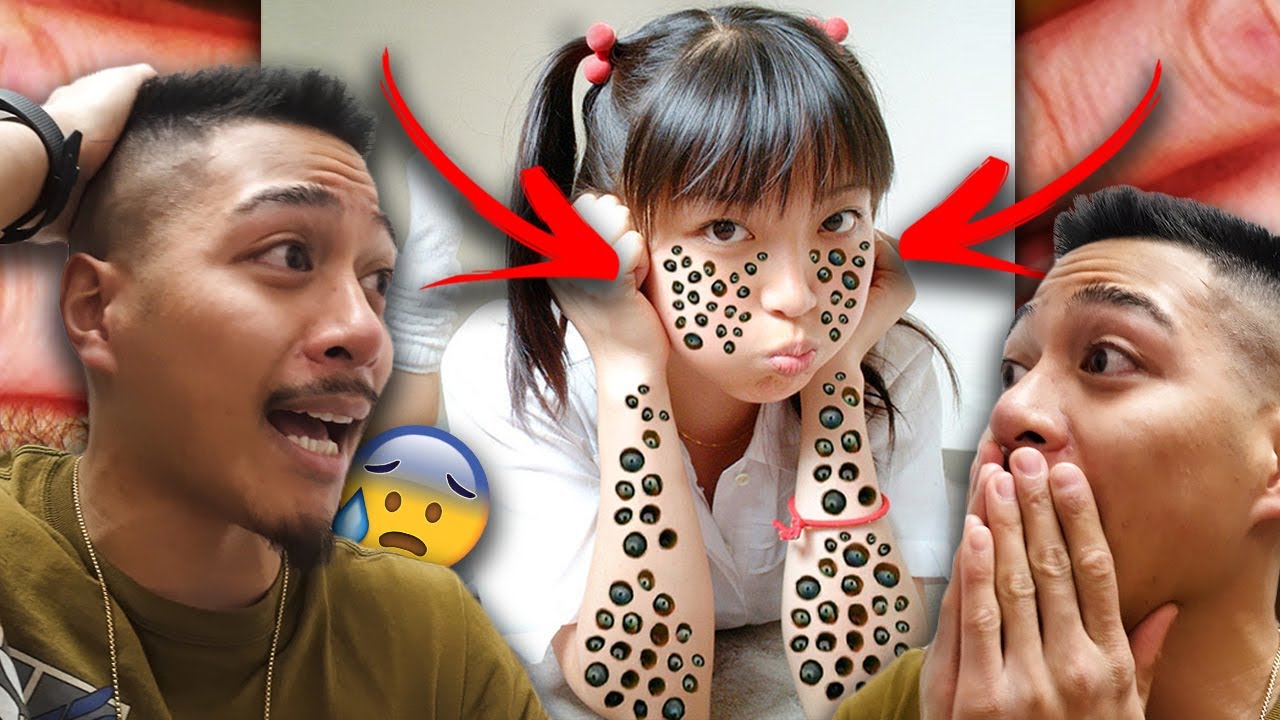 How I Cured My Trypophobia 😨 (WARNING YUCKY)