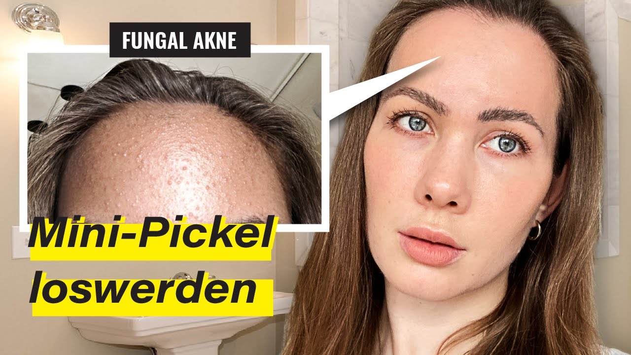 Mini Pickel auf der Stirn loswerden |  Fungal Akne