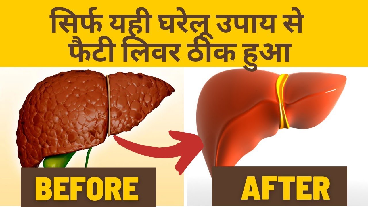 Fatty Liver Treatment | Fatty Liver Exercise | Fatty Liver Home Remedies | sgpt sgot