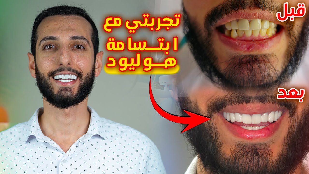 قبل ما تروح طبيب اسنان لازم تشاهد هذا الفيديو تجربتي مع ابتسامة هوليود