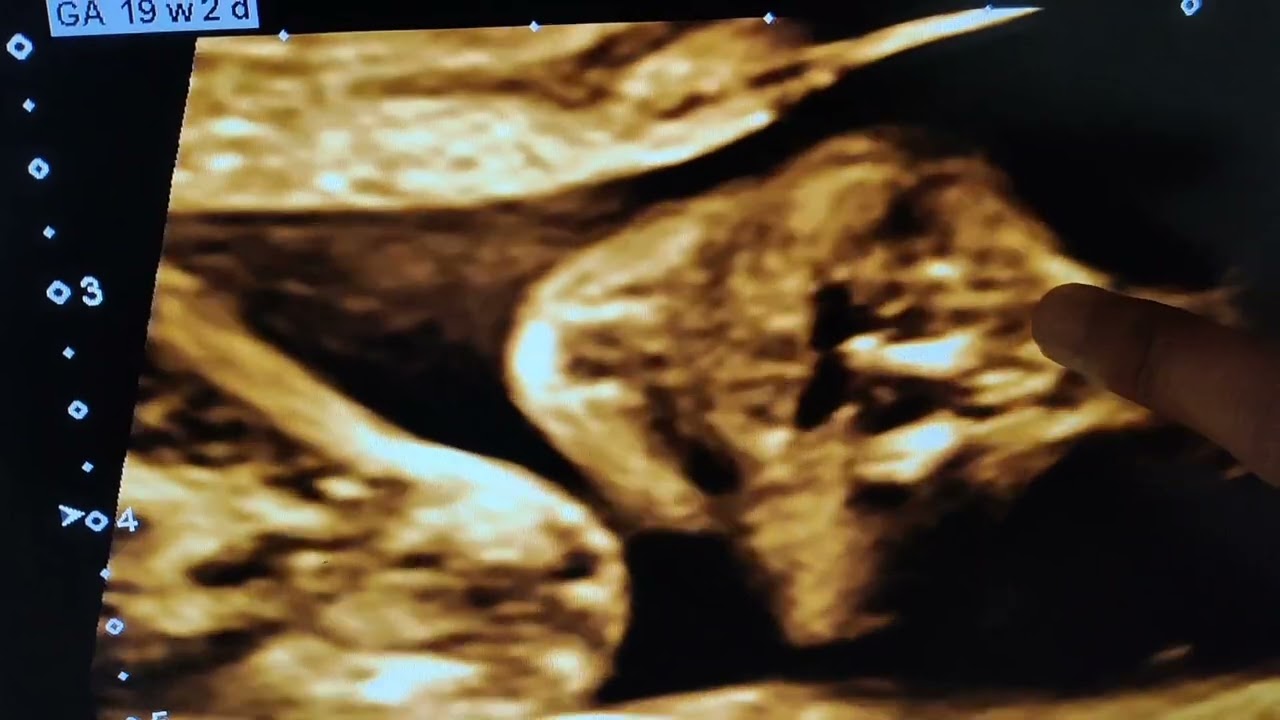 Iintrauterine Fetus baby FACE , NOSE ,LIPS . PLAYING WELL INSIDE ...Share MAXIMUM...#fetalmedicine