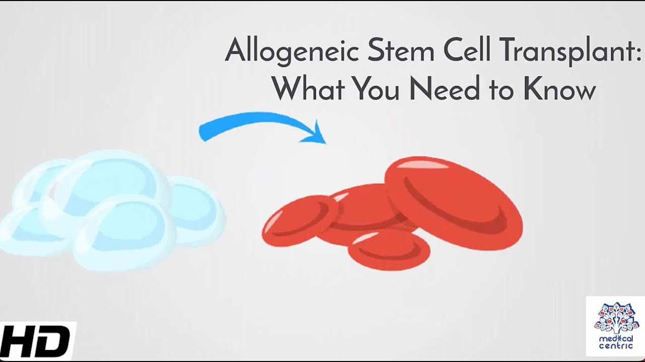 Allogeneic Stem Cell Transplant: What You Need to Know