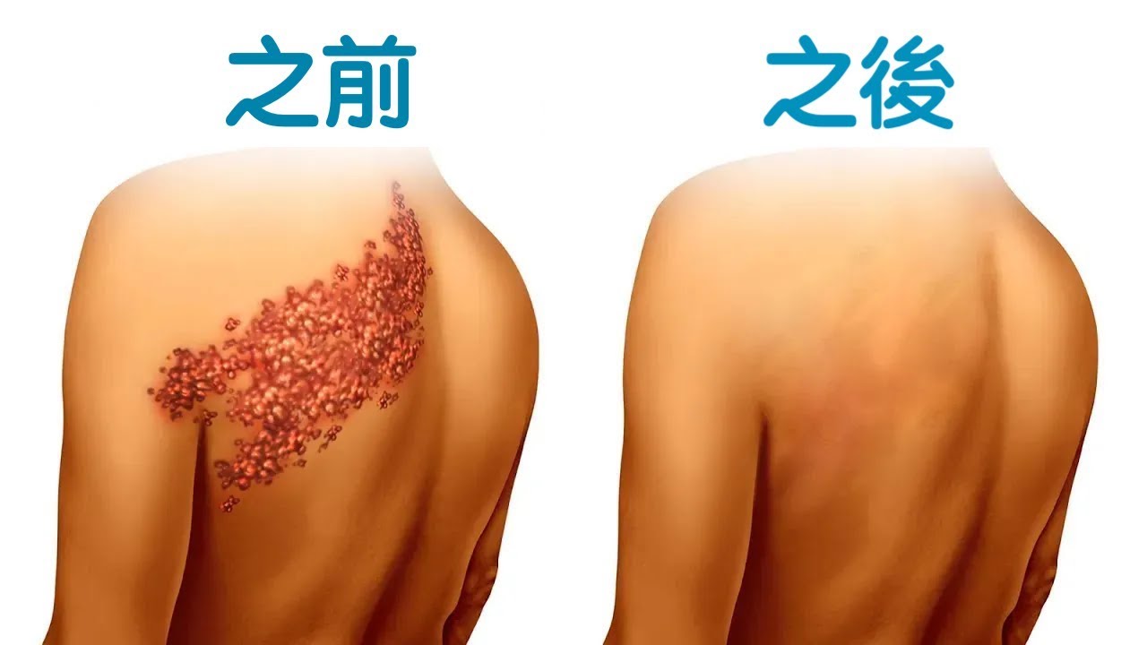 消除帶狀皰疹,自然療法,柏格醫生 Dr Berg