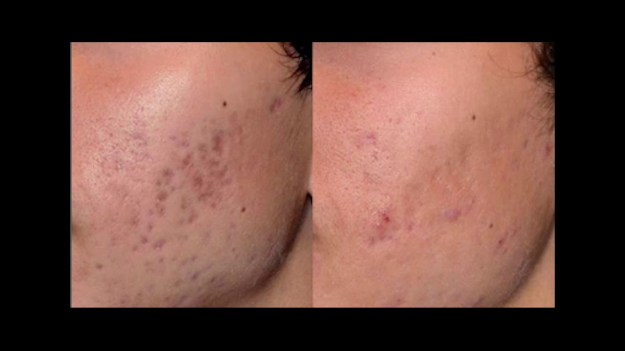 Teenage Acne Treatments in Harley Street