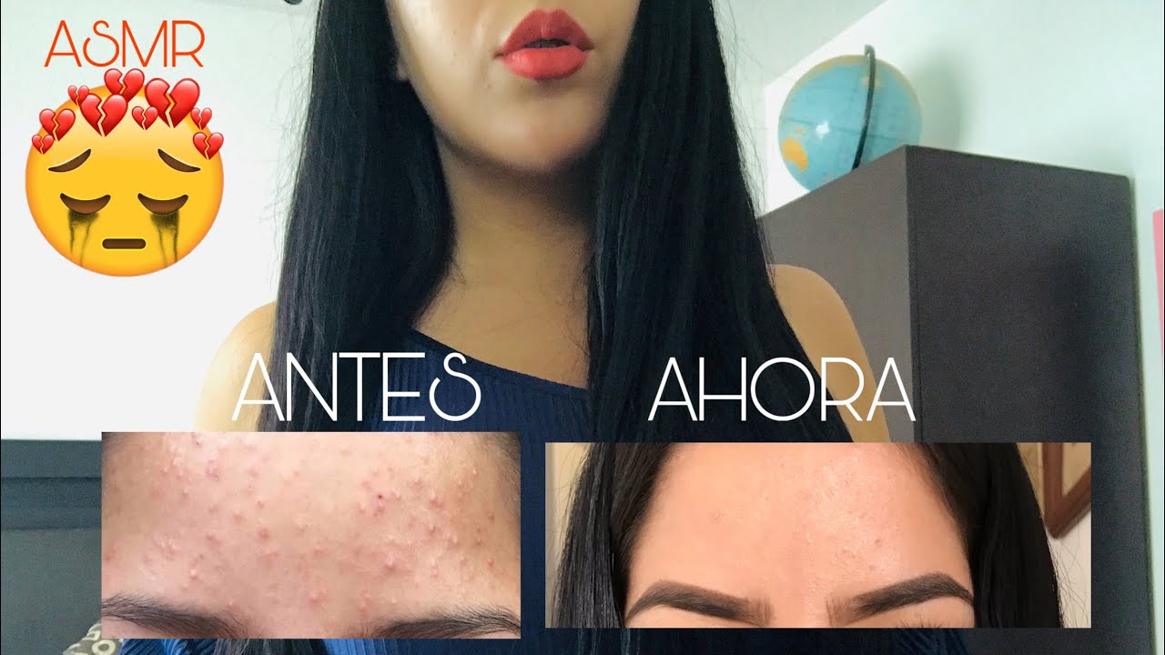 ASMR MI EXPERIENCIA CON EL ACNÉ🥺